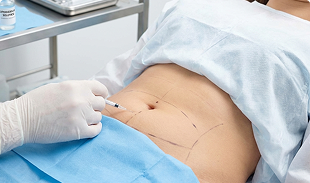 Intralipoterapia