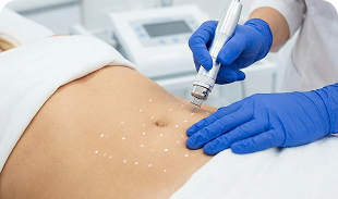 Mesoterapia